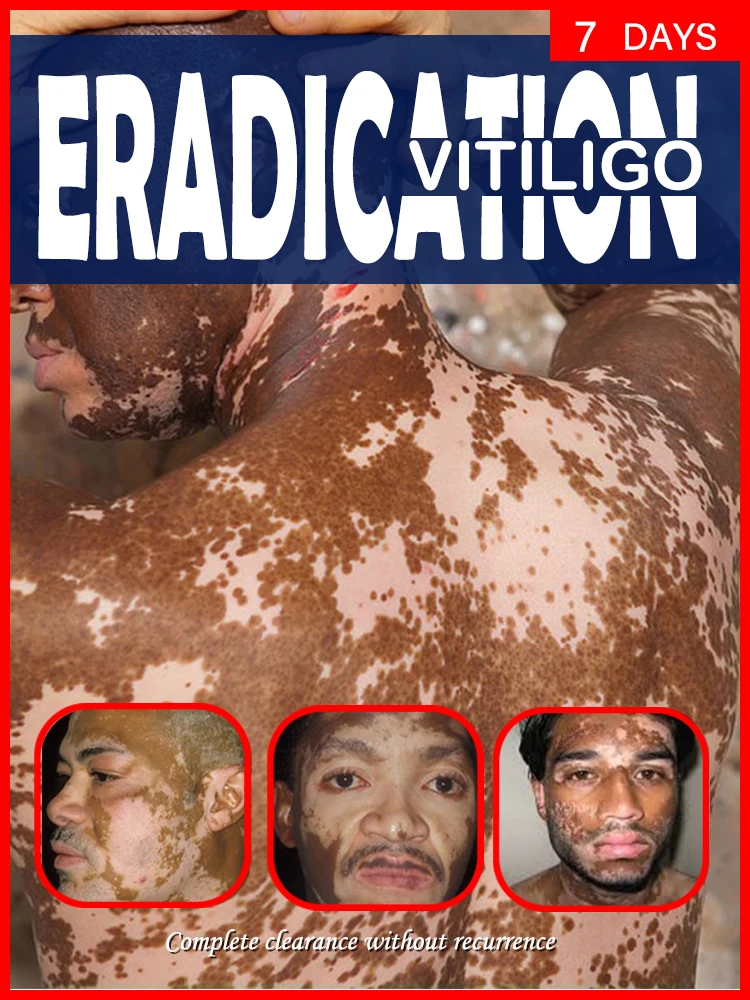 

improve vitiligo