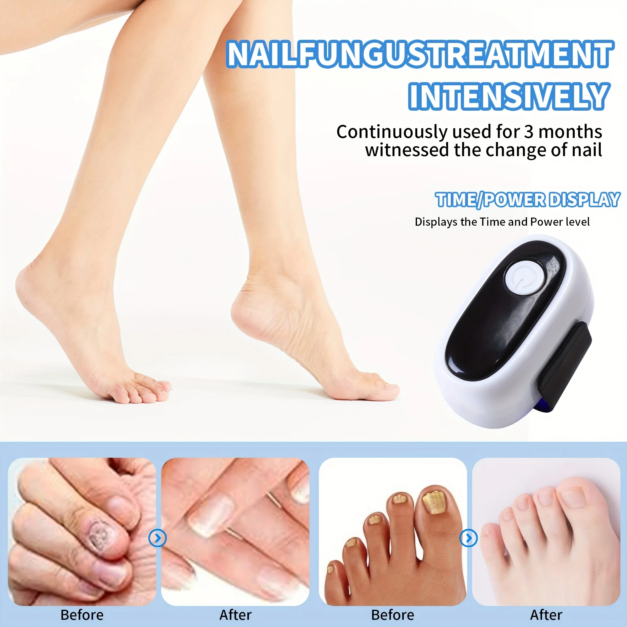 Nail Fungus Treatment Device 470nm Blue Light 910nm Infrared Light Anti Fungus USB Rechargeable Mini Portable Onychomycosis Therapy Tool