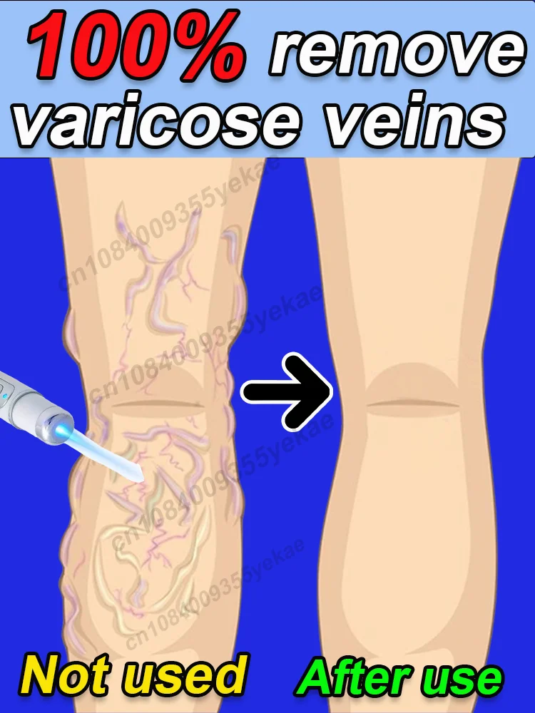 

Suitable for sensitive skin Improve varicose veins laser treatment