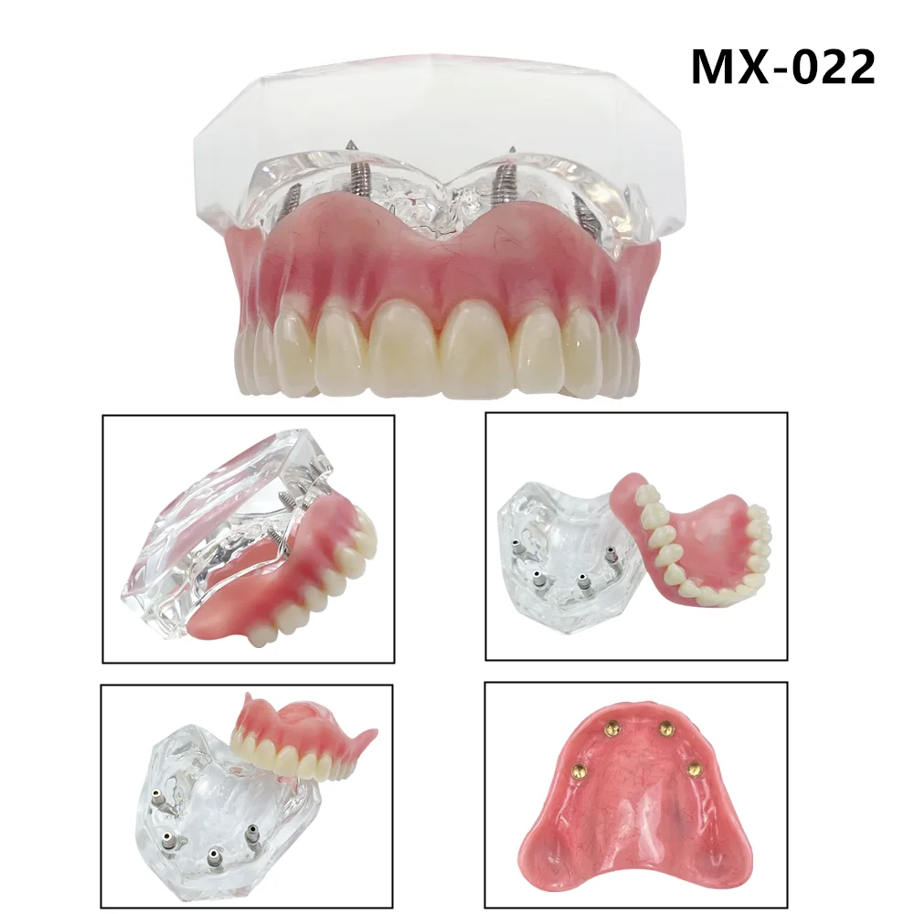 

Upper Lower Dental Implant Teeth Model Clear Dental Model Teeth Implant Restoration Bridge Removable For Education Teaching Demo