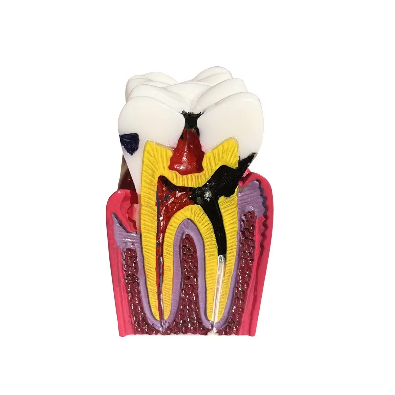 Dental Exam Practice Pulp Cavity Tooth Model Root Canal Extracted Tooth with Cavity Preparation for Dental Students Training