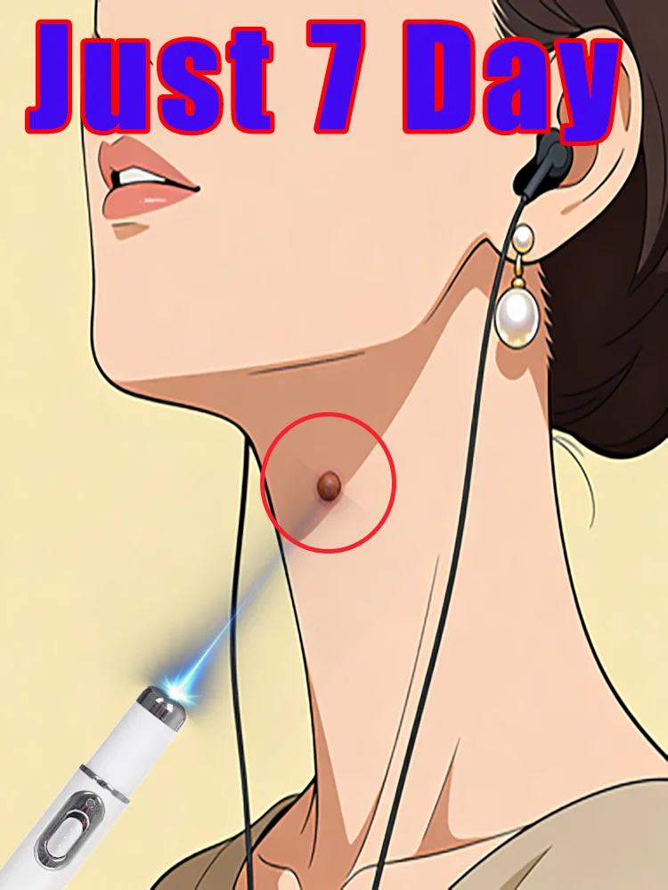 Tratamiento de pluma láser de esterilización profunda para verrugas planas Condiloma Aluminio y varias verrugas Eliminación física indolora de verrugas