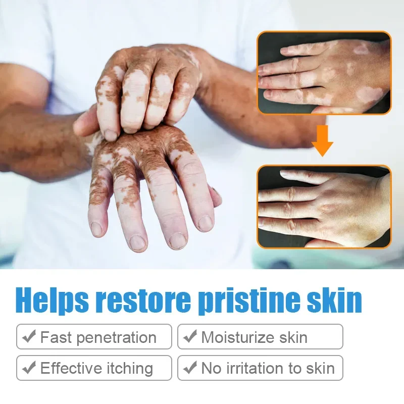 Organic Vitiligo Treatment Cream With Herbal Extract for White Spot Ringworm Removal