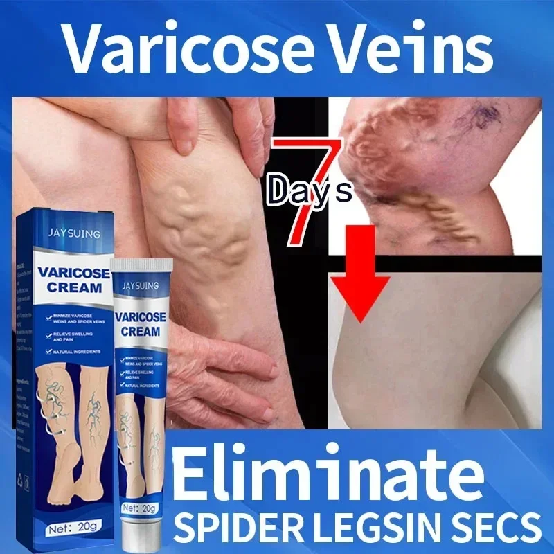 Pomada para venas varicosas, crema efectiva para aliviar la Vasculitis, flebitis, tratamiento del dolor de araña, cuidado de los pies