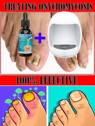 Fungal Nail Laser Onychomycosis Fungus Nails Repair Fast