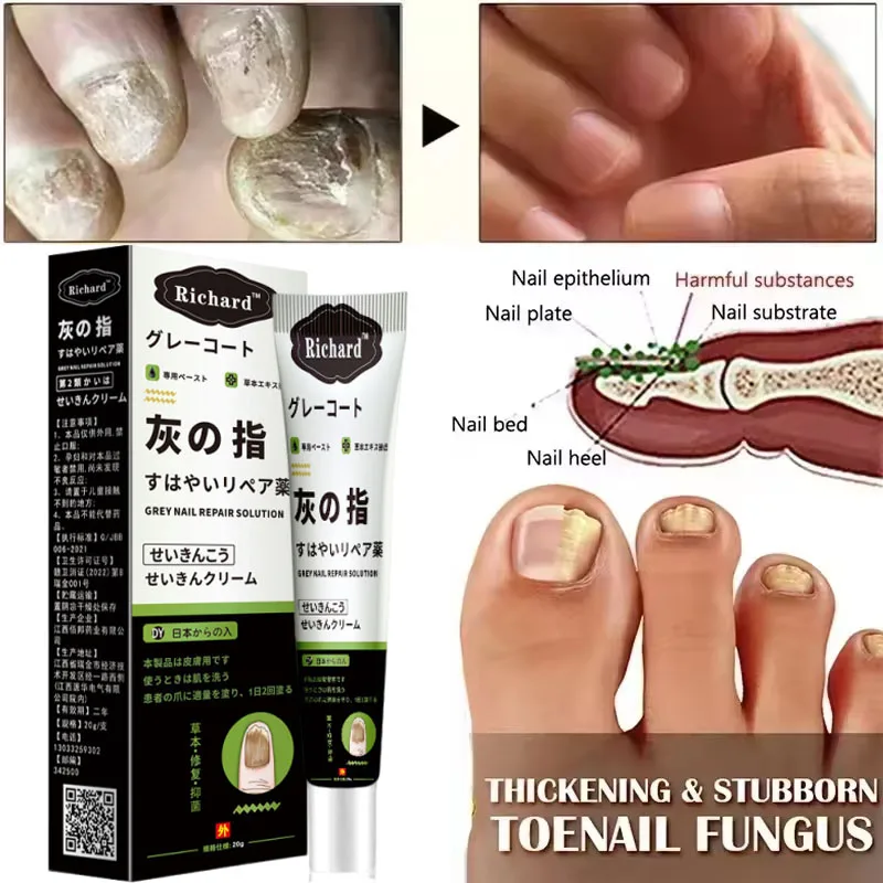 كريم علاج فطريات الأظافر القدم تو إزالة فطريات الأظافر زيت طبيعي مكافحة العدوى فطار الداحس إصلاح الرعاية #3