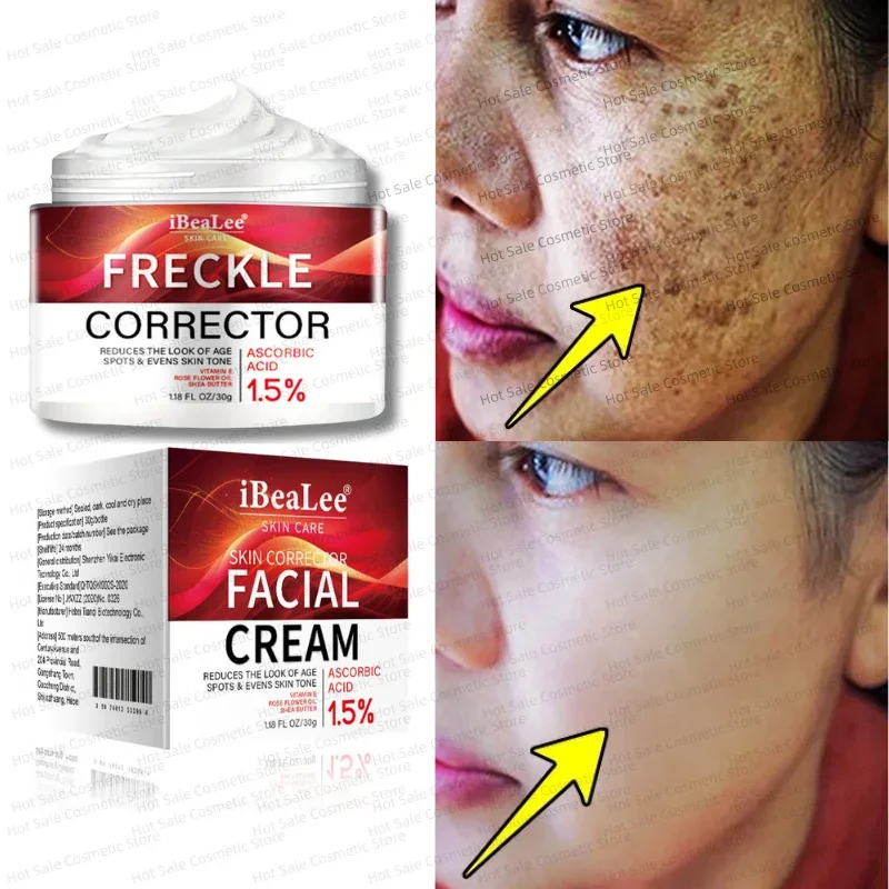 Verwijderen Black Dot Gezichtscrème Sproet Corrector Witter Melasma Anti Bruine Vlek Lichter Pigmentatie Hydrateren Gezichtsverzorging