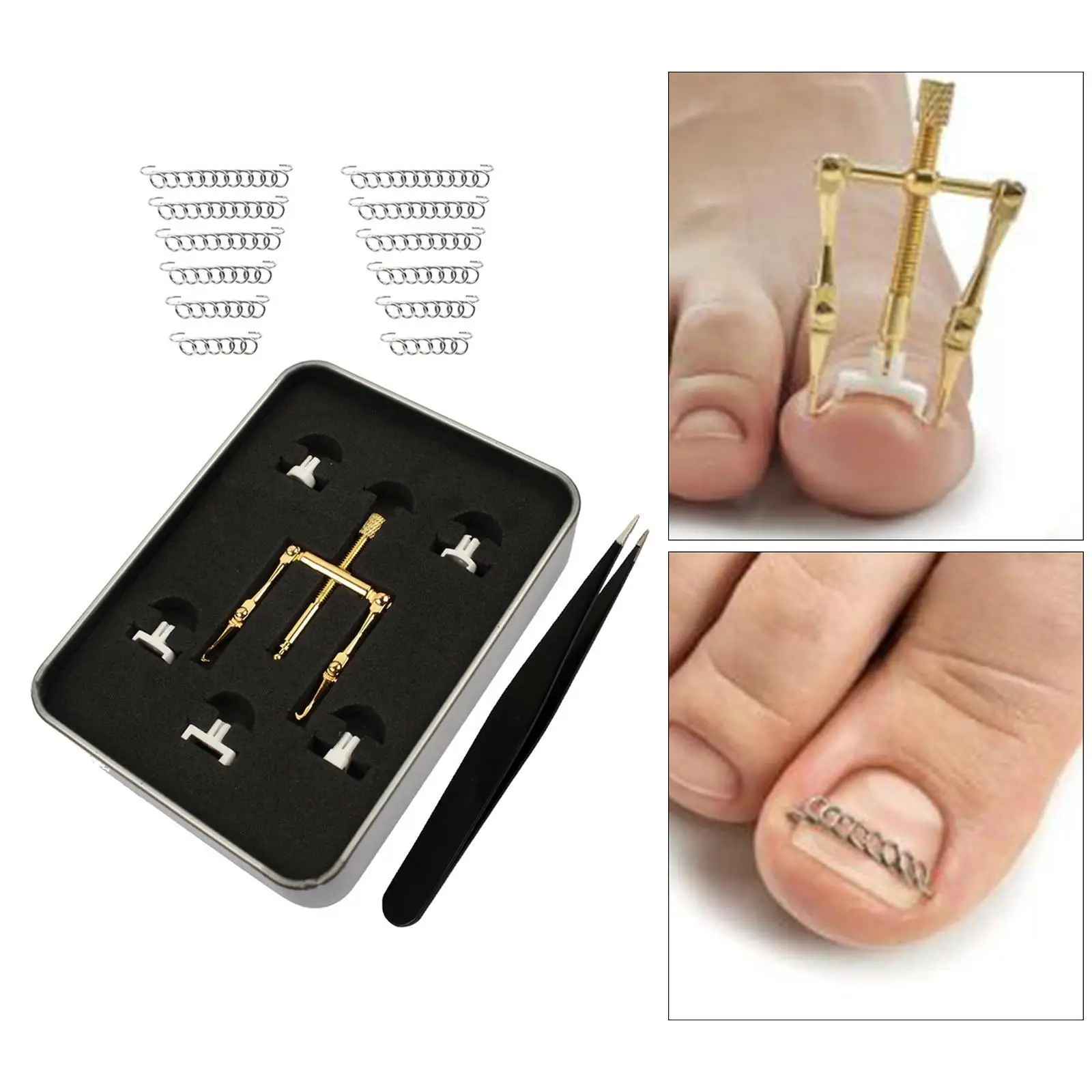 علاج أظافر القدم الغارزة، مشبك تنعيم للأظافر