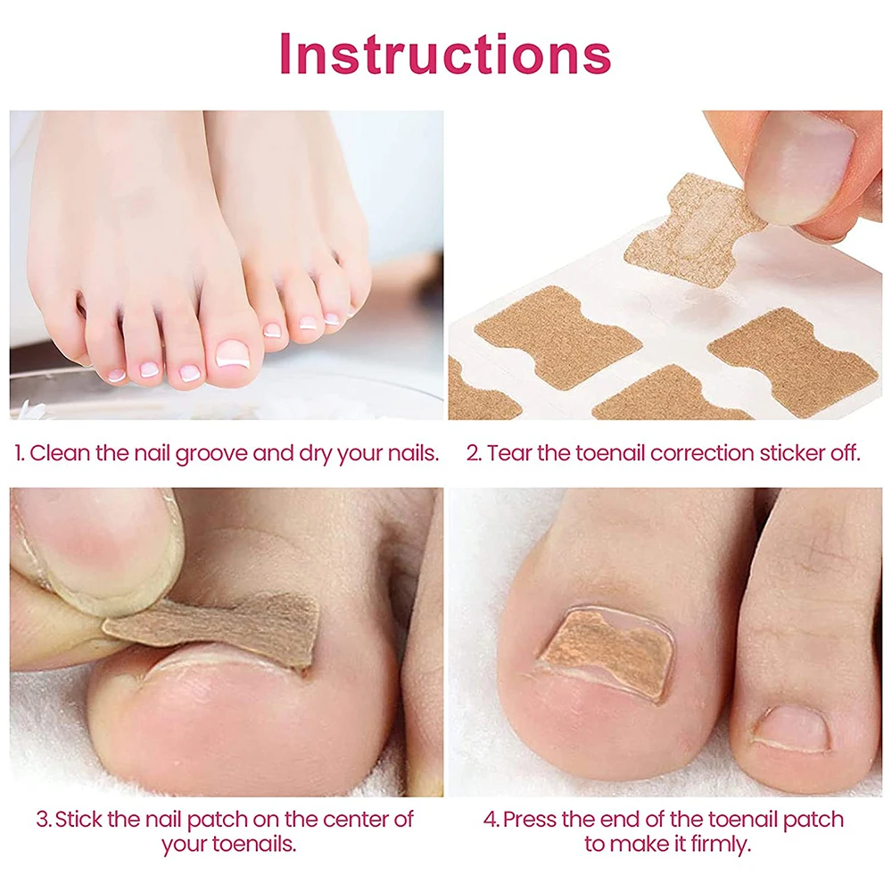 50/100pcs Ingrown Toenail Corrector Patches Nail Correction Care Stickers Paronychia Treatment Recover Corrector Pedicure Tool