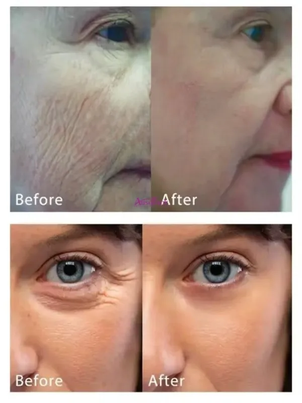 Fractionele RF Huidverstrakking Rimpelverwijdering Gezichtslifting Verjongingsapparaat Anti-agingapparatuur Vervangbaar 64 36 4 koppen