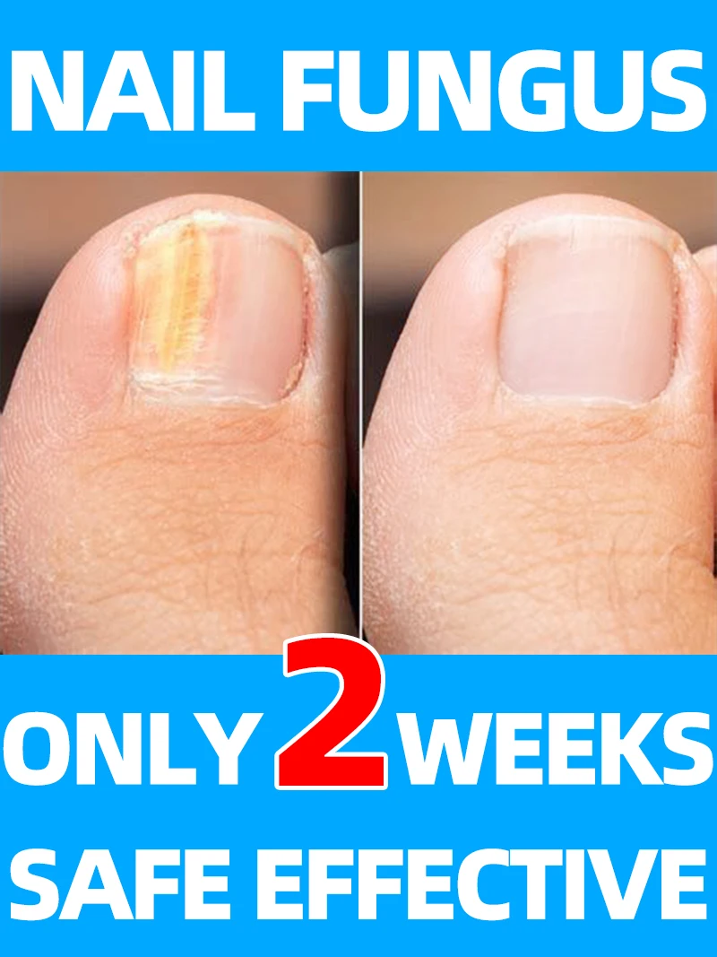

toenail fungus laser nail uv portable nail care