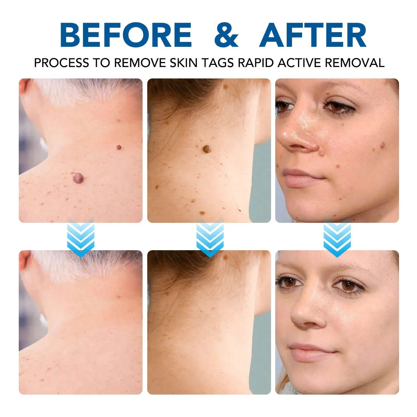 痛みのないいぼ除去装置,にきび治療ペン,家庭用