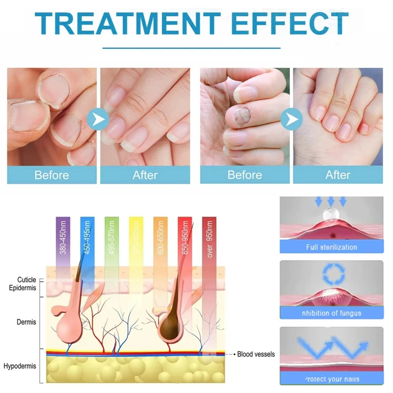 Dispositivo de tratamiento de hongos de uñas con láser, reparación de uñas encarnadas, Corrector de hongos de uñas, molde de Podología, uñas láser con hongos