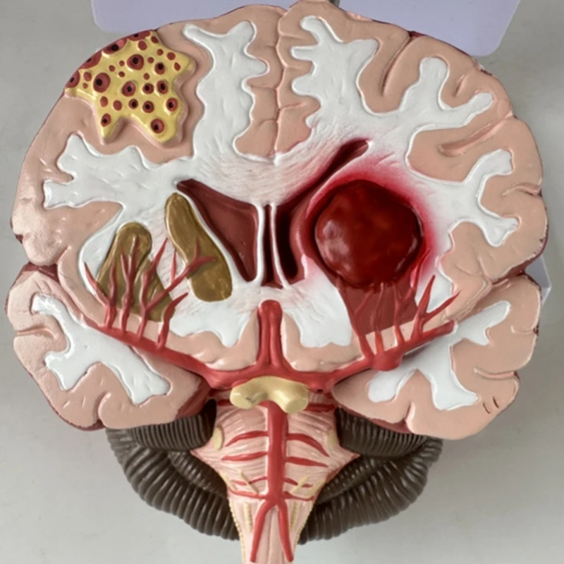 Top-Human Brain Disease Model - Brain Pathology Brainstem Hemorrhage  Teaching Model - Human Brain Anatomy Model