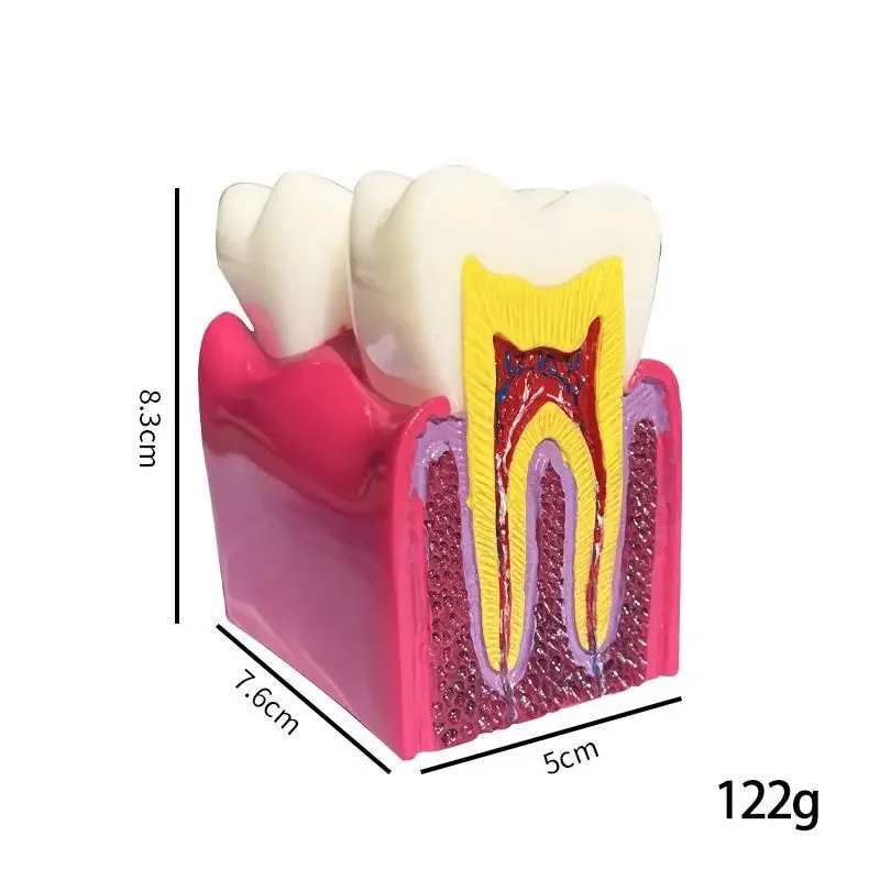 Dentistry, Oral 6x Caries Comparison Model Caries Process Evolution Doctor-patient Teaching Communication Display Model