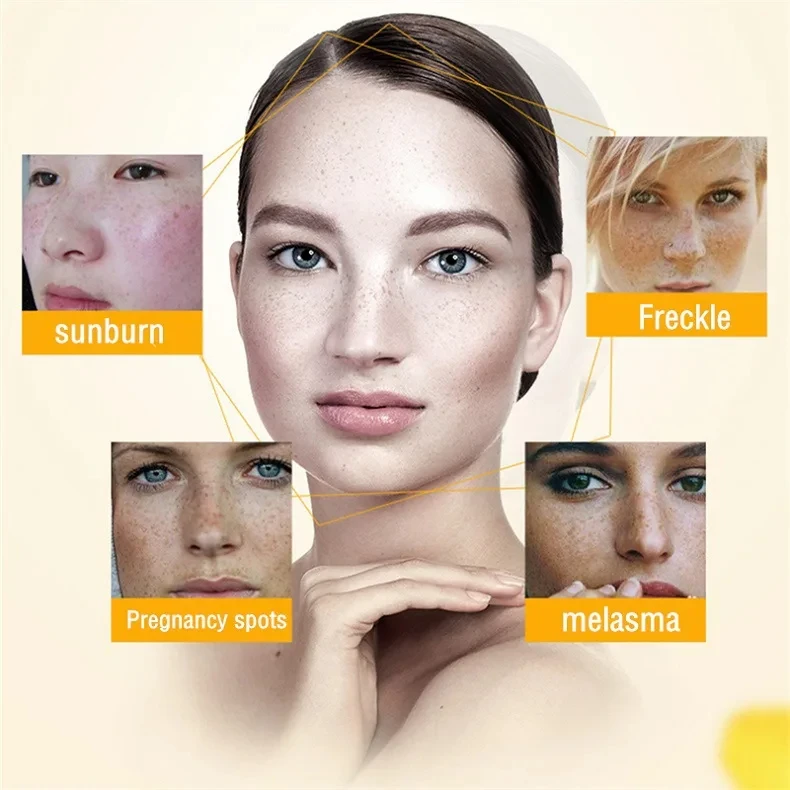 Whitening Freckle Cream Remove Dark Spots Remove Melasma Anti Freckle Cream Fade Pigmentation Anti-Aging Light Skin Care