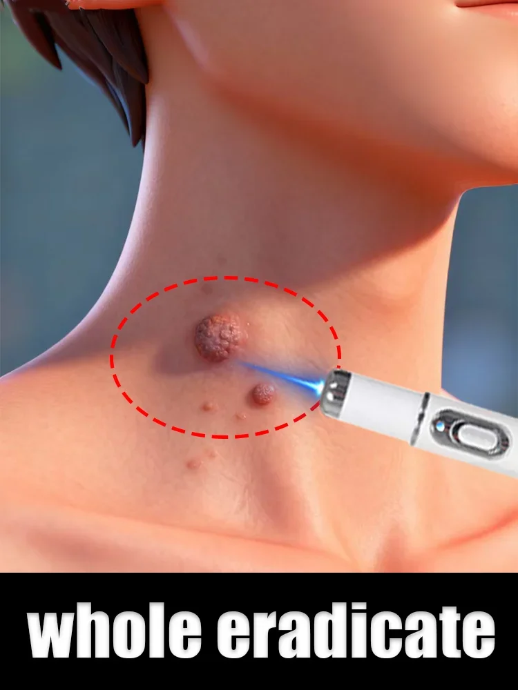 

Wart Care Kit for Perennial Warts blue light pen