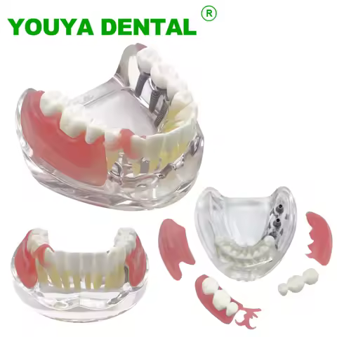 Dental Implant Model With Restoration M6006 Overdenture Inferior Demo Mandibular Teeth Model 3 Implants Bridge Dentistry Product