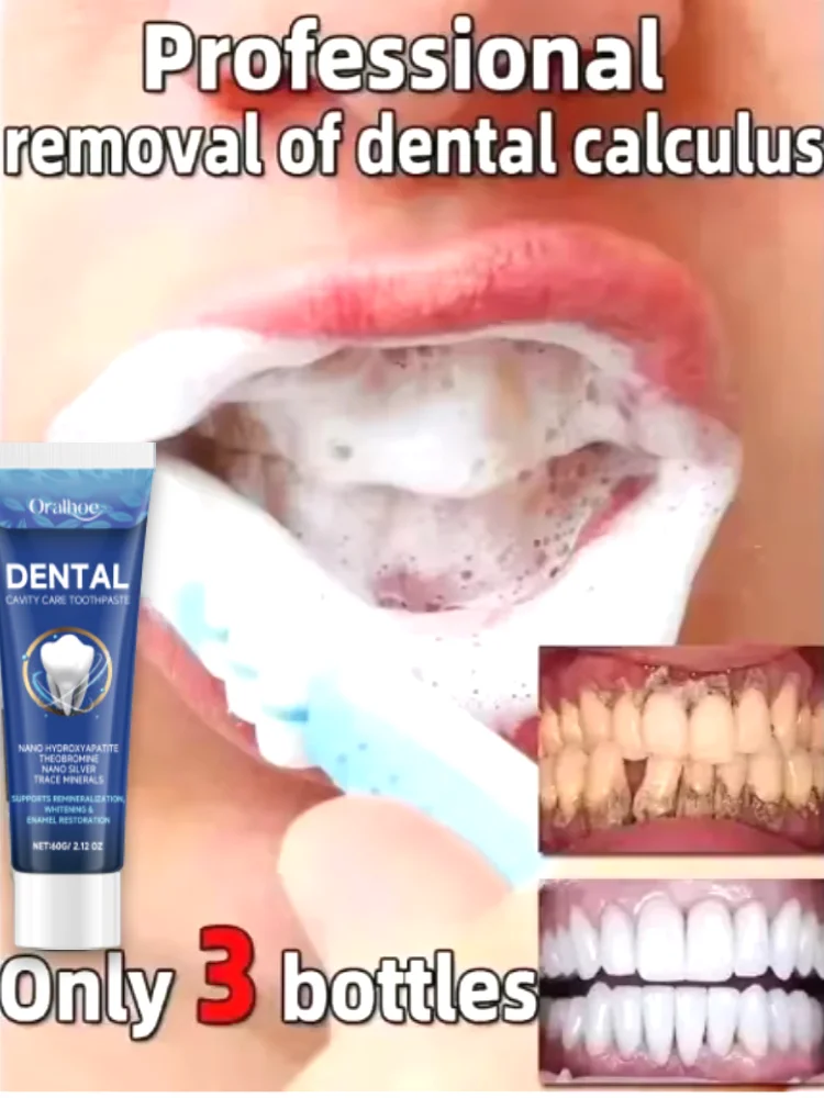 

Calculus Remover Whitening Remove Bad Breath Teeth Toothpaste Toothpaste Whitening Teeth Cleaning Care Teeth whitening products