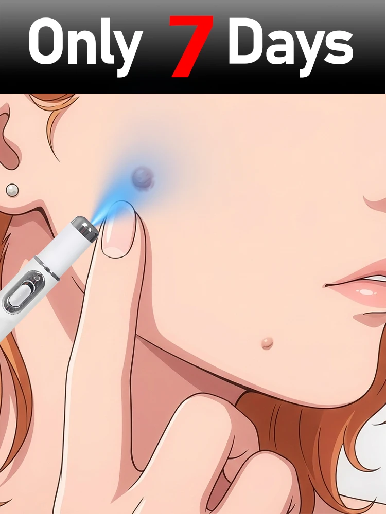 

Ручка с синим светом для удаления бородавок, инструменты для ухода за бородавками, унисекс, акционная скидка