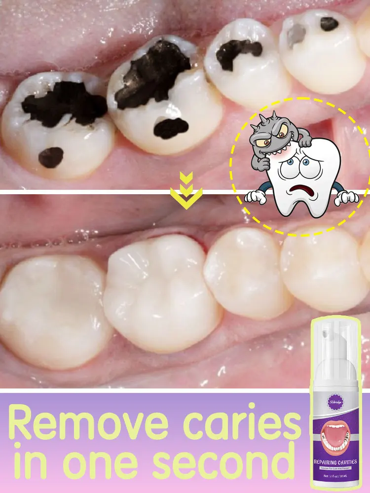 Solves caries and teeth decay problem