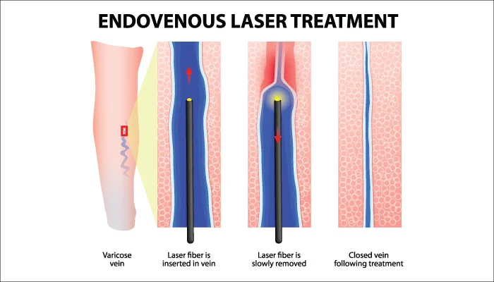 Arfurla Medical Varicose Vein Fiber EVLT Radial Fiber