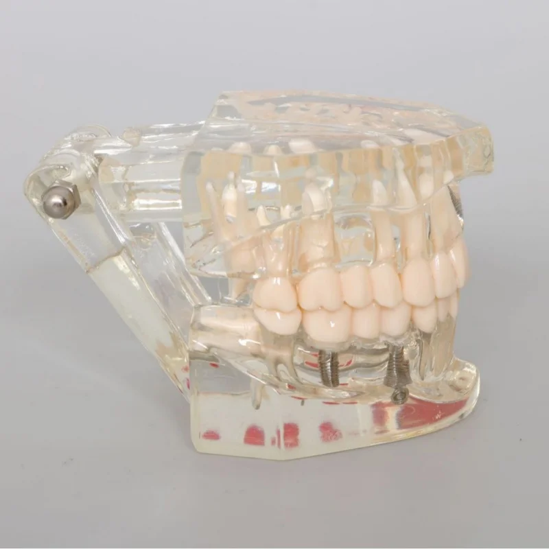 High quality transparent dentistry Oral transparent restoration dental implant model