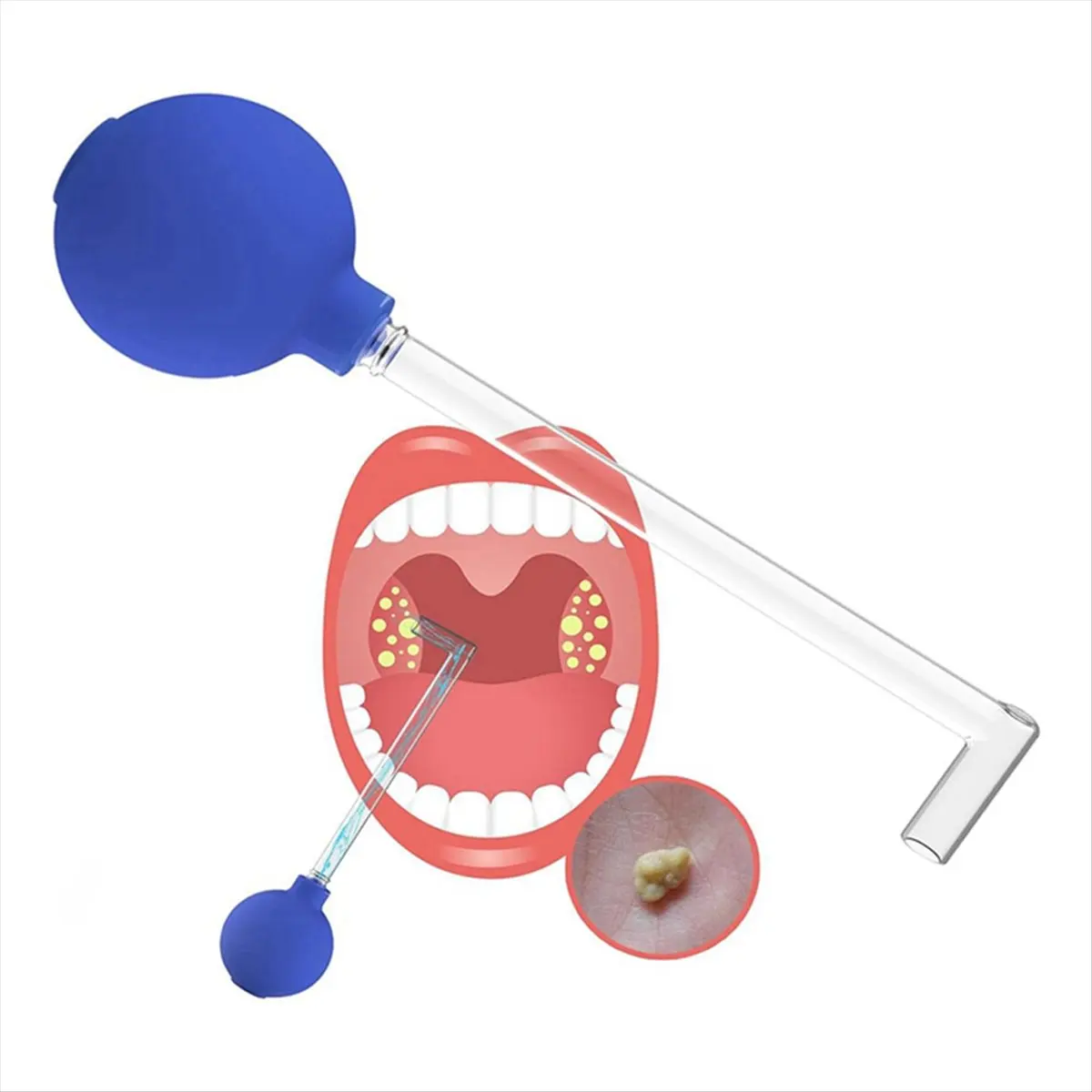 *A02R Aspirador removedor de piedras de amígdalas, kit removedor de piedras de amígdalas, herramienta de eliminación de piedras de amígdalas, limpieza bucal de estilo manual