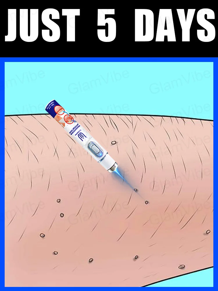 

2025 New Upgrade Blue Laser Solve Wart Tool