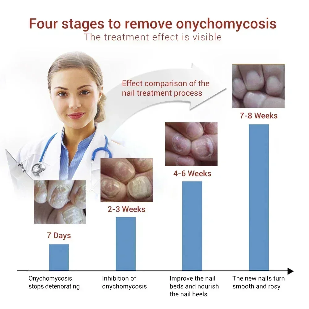 Siero per il trattamento dei funghi delle unghie prodotti per la riparazione dei funghi dei piedi Gel per la cura dei piedi delle mani Anti infezione onicomicosi paronichia