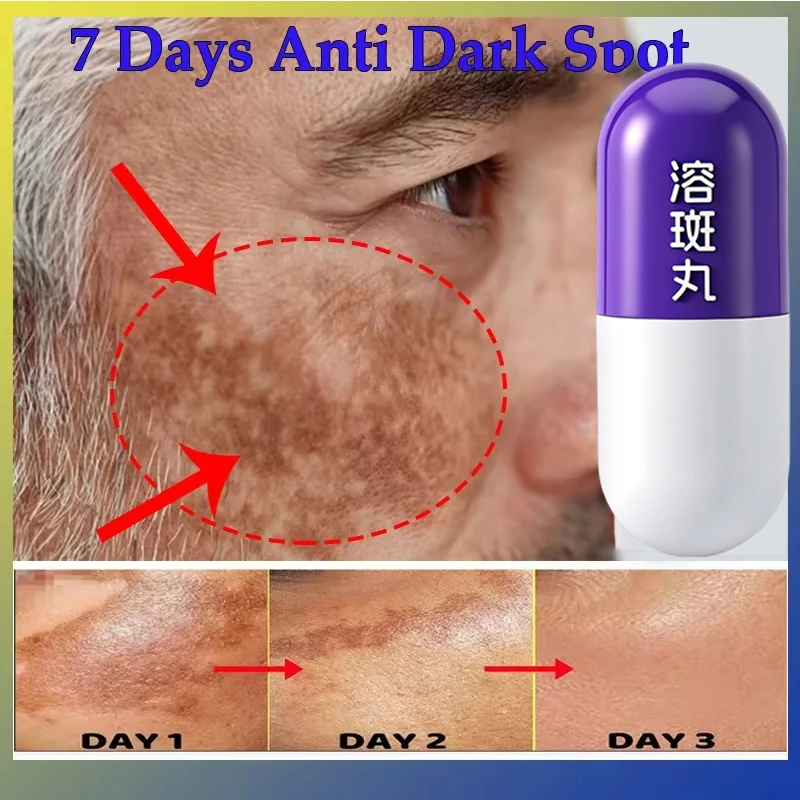 فعال تبييض النمش إزالة أكوا جوهر 377 بقعة حبوب تذويب إزالة الكلف تتلاشى التصبغ سطع العناية بالبشرة #3