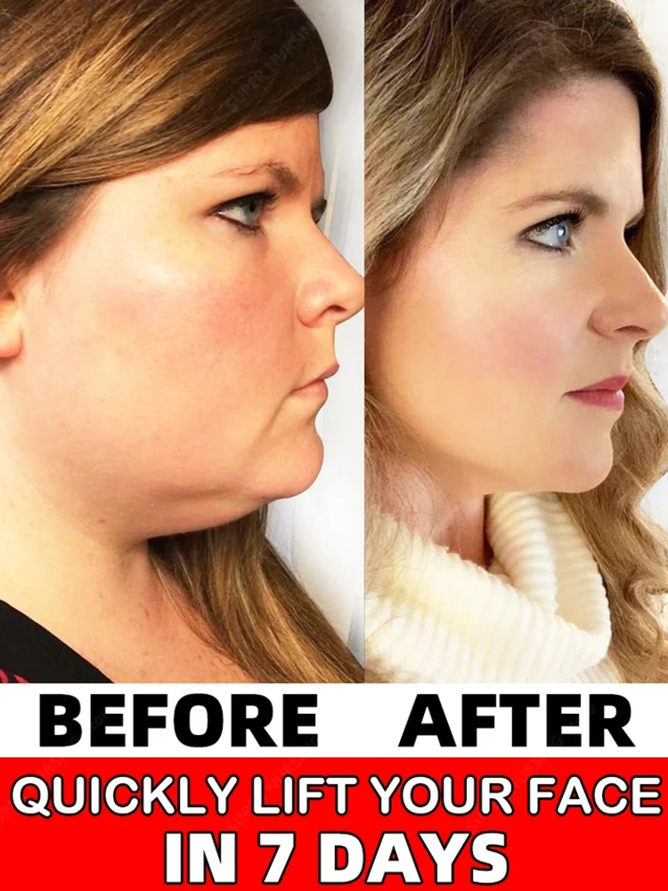 

Remove double chin v lifting