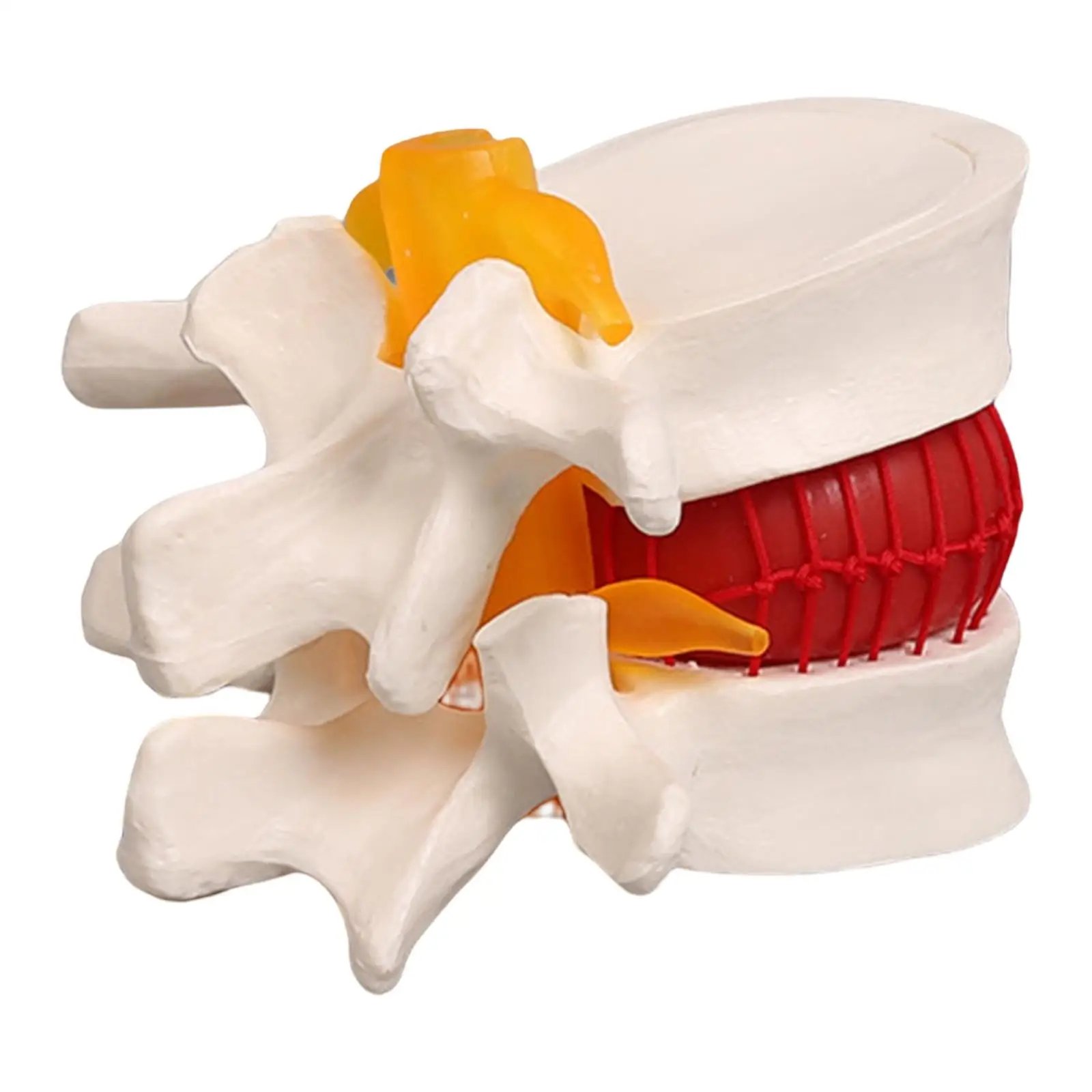 Lumbar Spine Disc Protrusion Model - Educational Resource for Educators