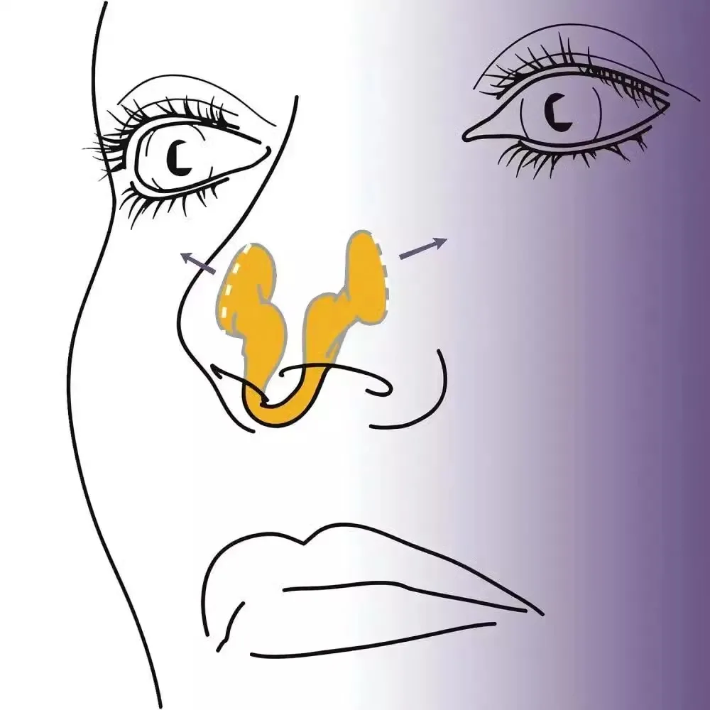 Dispositivo anti-russamento in silicone morbido con scatola Saling Facilare la respirazione e il russamento Dispositivo anti-russamento per il sonno Dilatatore nasale