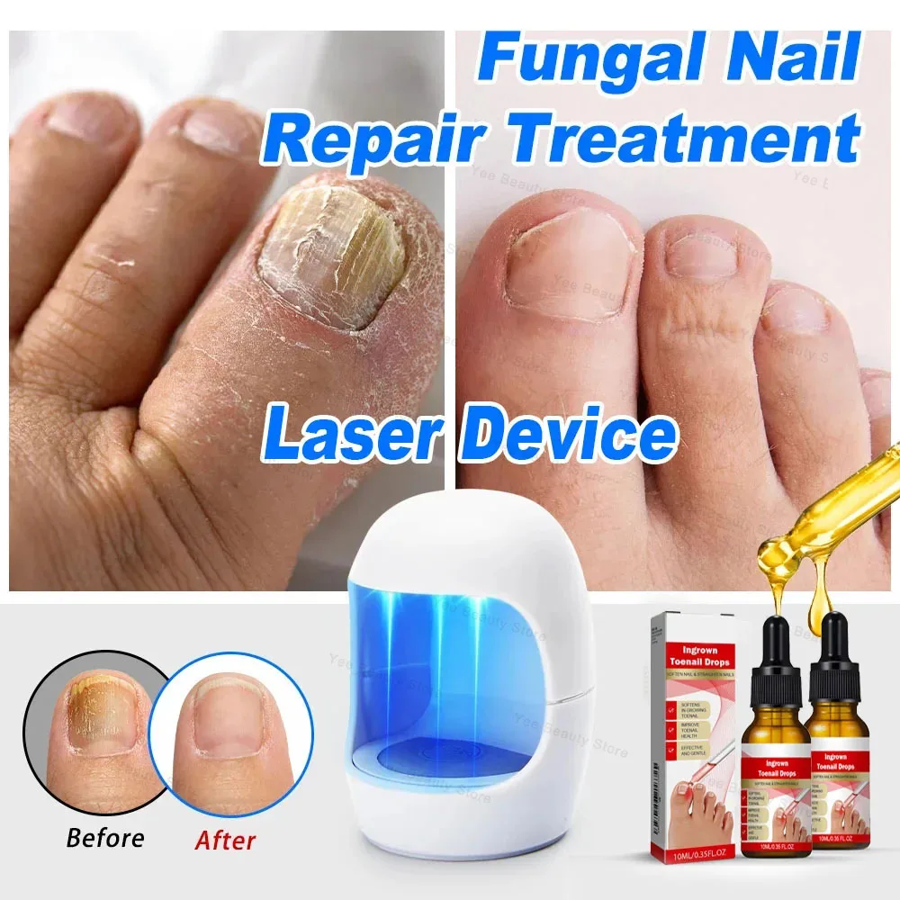 Fungal Nail Device Repair Fast Nails Fungus Onychomycosis