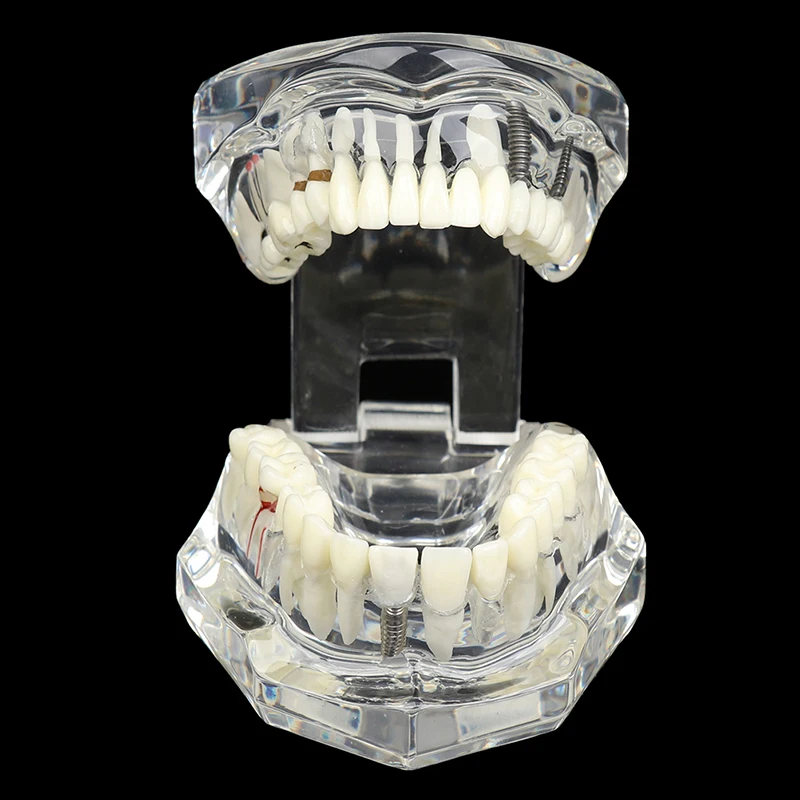 Modele dentystyczne zdejmowane i odnowione modele chorych zębów do nauczania i badania chorób medycznych i stomatologicznych