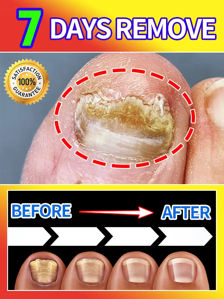 

Blue light device Solve Toenails problems