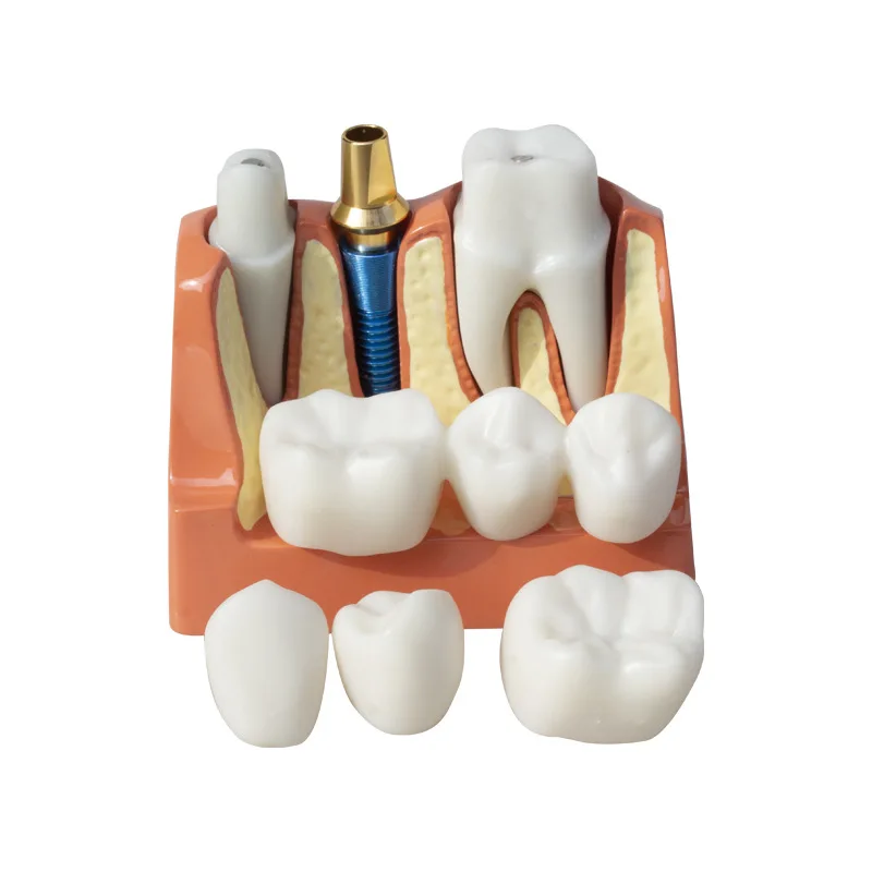 Dental 4x Implant Solution Model Denture Repair Implant Explanation Removable Bridge Crown Implant Model