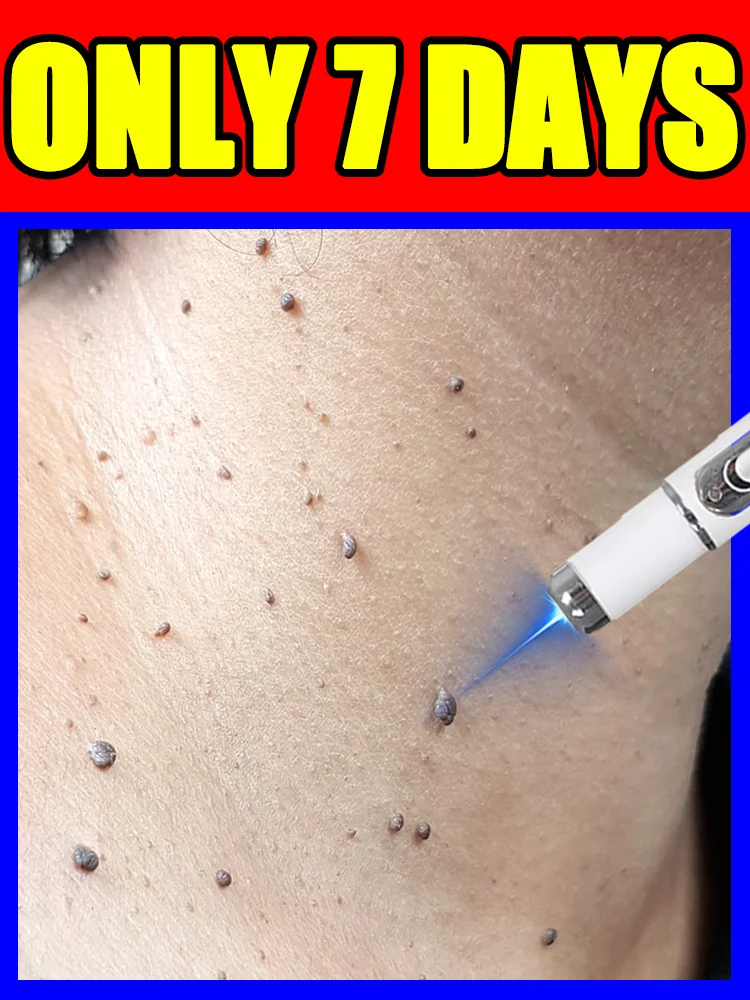Blue Light Pen Solve Warts, Free Shipping, Hotsale Wart Care Tools, Feet, Shoulders, Neck, Head, Hands, Painless, Quickly