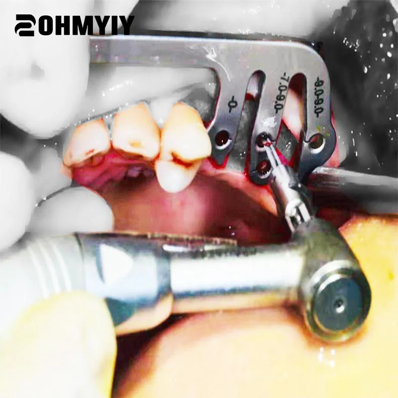 

Dental Implant Guide Set Boxed Oral Planting Locator Positioning Guide Drilling Positioning Ruler Dental Scale Implant Tools