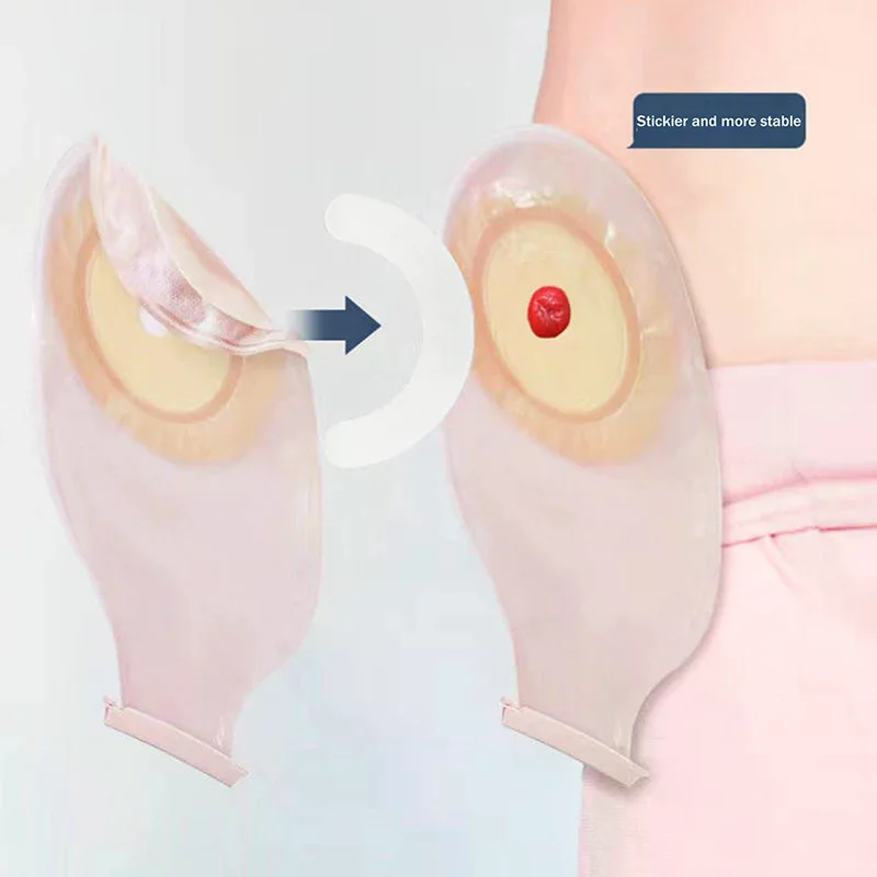 10Pcs Barrier Stoma Ostomy Strips Tape Strip Rings Adhesive Pressure Fixing Colostomy Leak Proof Colostomy Bag Barrier Strip