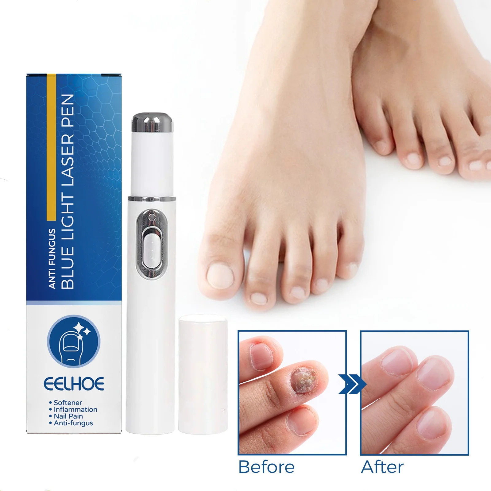 เครื่องเลเซอร์รักษาเชื้อราที่เล็บ อุปกรณ์ดูแลเท้าสำหรับการรักษาเล็บ ป้องกันการติดเชื้อ รักษาโรคเล็บขบและโรคเชื้อราที่เล็บ