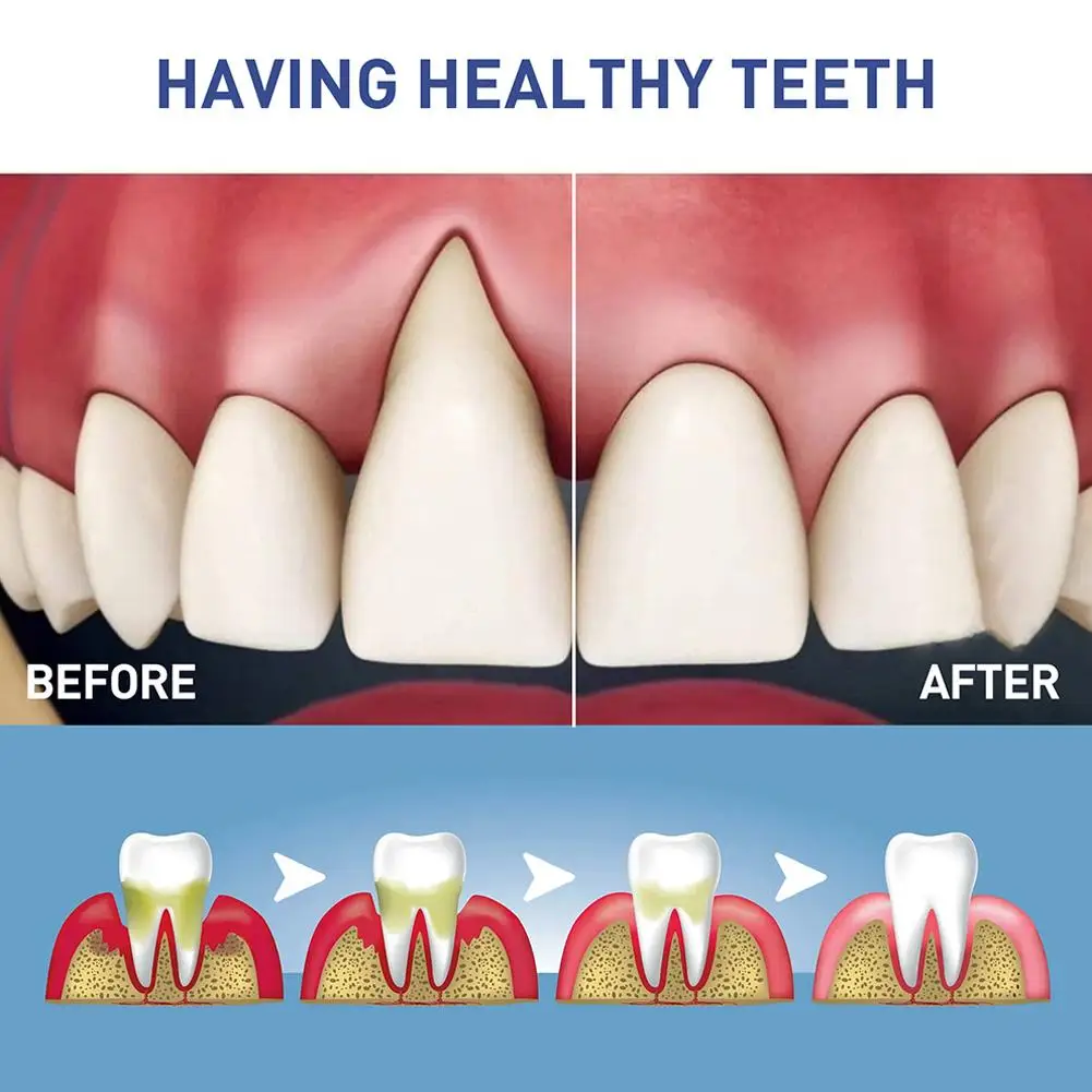 4Ml Verzachtende Antiseptische Gelbehandeling Ontstoken Tandvlees Mondzweren Mondweefsel Tong Tandpasta Voorbijgaande X2p6