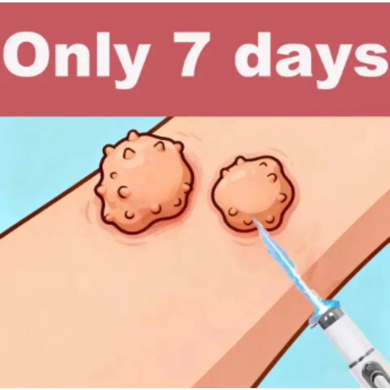 

Синий лазерный указатель 1-го поколения, обновленный, для удаления бородавок, быстро