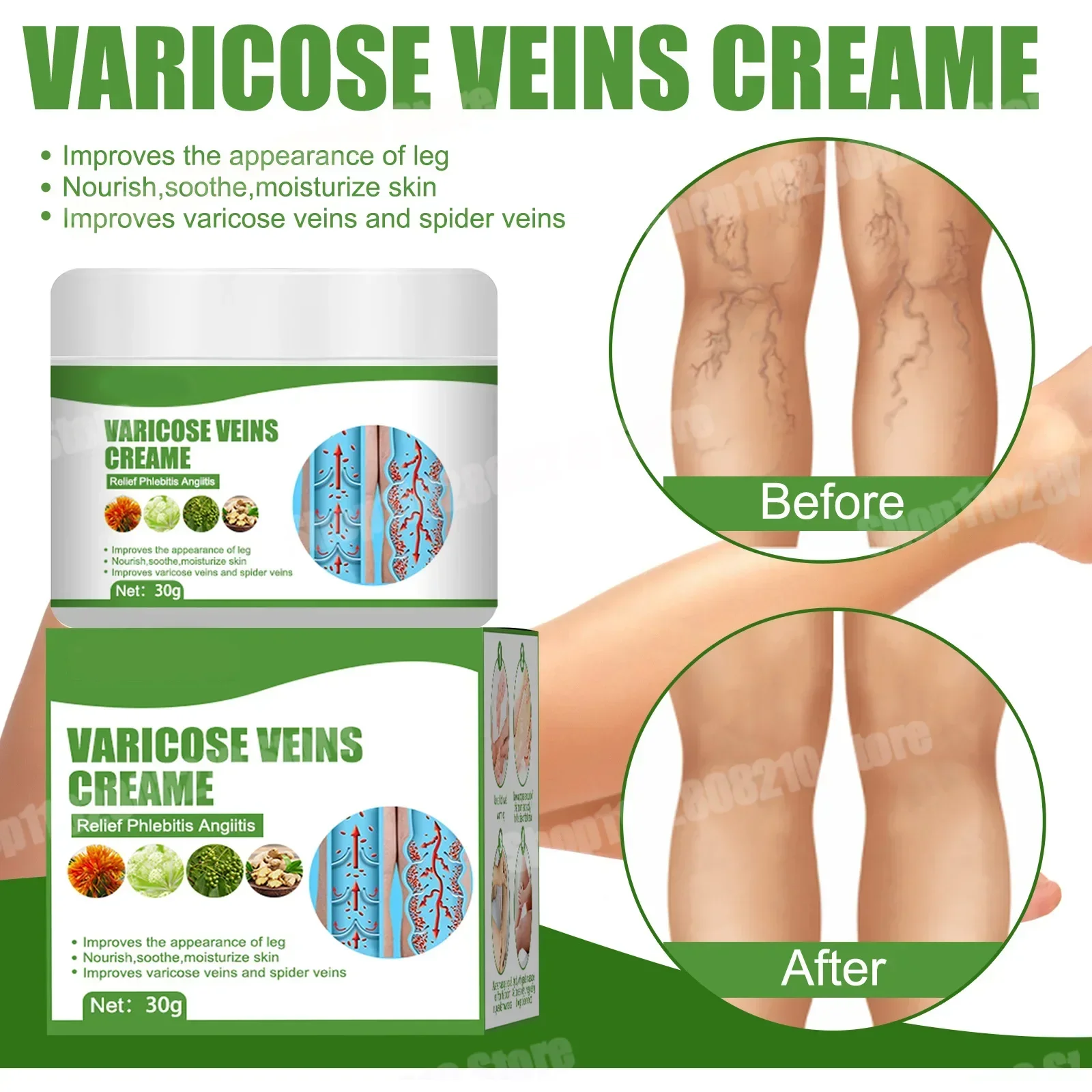 Creme de tratamento de veias varicosas, remove estrias vermelhas no sangue, varicocélula, vasculite, flebite, fortalece a saúde capilar