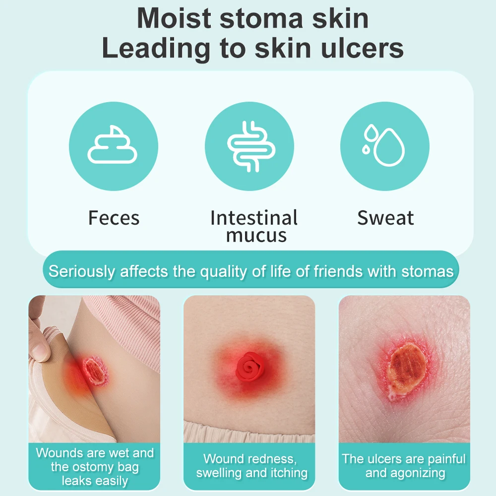 Рисунок 2 - защита кожи от стомы без спирта