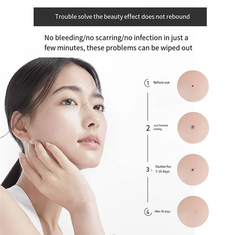 Mole Spotting Pen Laser Spotting Pen Beauty Instrument Painless Spotting Pen Silver Gray 1Set