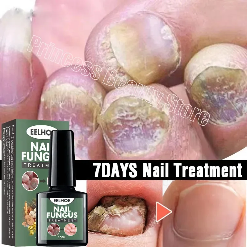 

Powerful Nail Fungal Treatment Serum Anti-infection Foot Toe Nail Fungus Removal Gel Onychomycosis Paronychia Repair Feet Care