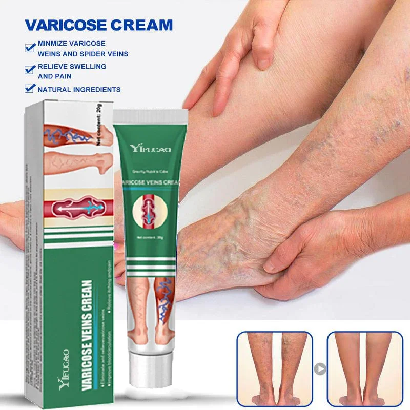 Creme eficaz do tratamento da veia varicosa, aliviar as pernas, vasculite dilatada, flebite, pomada fórmula natural