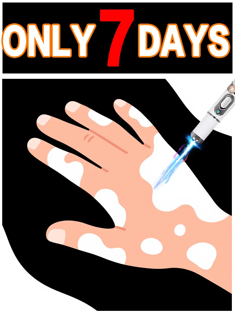 Caneta de luz azul remove rapidamente o vitiligo, uma ferramenta mais vendida para cuidados com a vitiligo.